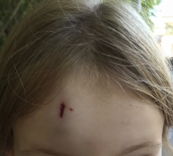 Son scratched and pinched on face at school