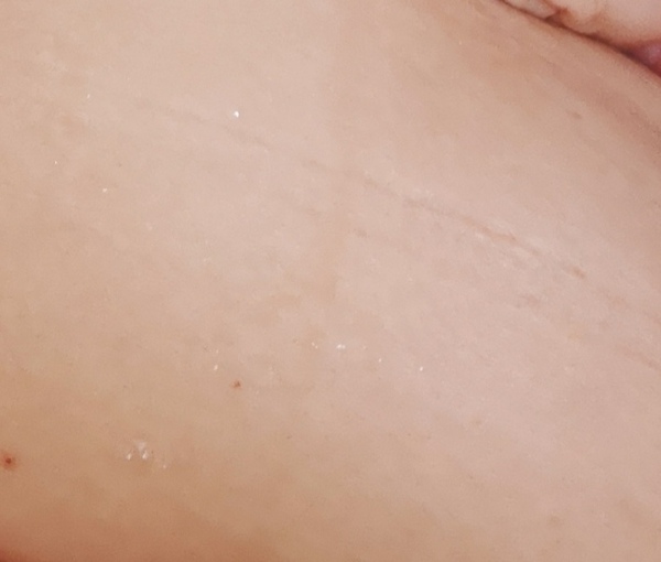 Linea negra on tummy hasn't disappeared !