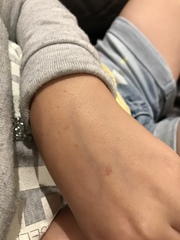 Tiny purple spots on DDs leg