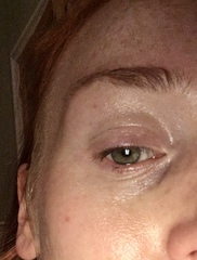 Would you botox these eyes?