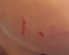 Son scratched and pinched on face at school