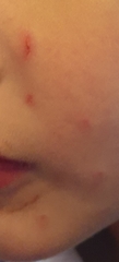 Son scratched and pinched on face at school