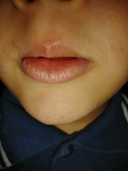 Swollen top lips