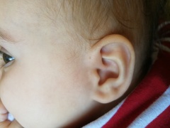 Not too exciting but a recurring Thing on 6mos ear?