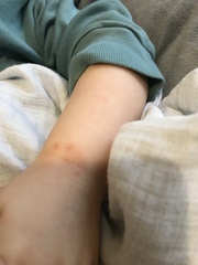 Impetigo - pic attached