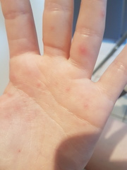 Painful blisters all over my hands and fingers, ideas!?