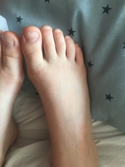 DS 11 can’t weight near after fall - A&E or wait and see?