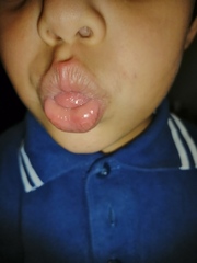 Swollen top lips