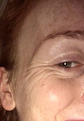 Would you botox these eyes?