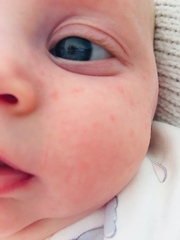 Baby face rash?
