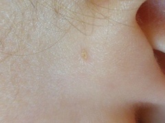 Not too exciting but a recurring Thing on 6mos ear?