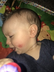 Impetigo - pic attached
