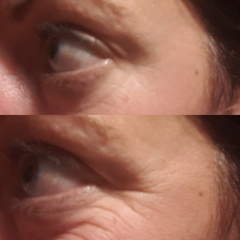 What can I do about my laughter lines?