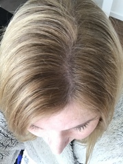 Freaking out over this hairloss!!!