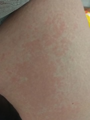 About this random middle of the night rash?!