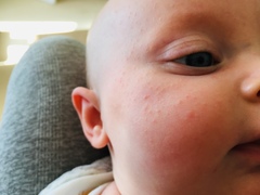 Baby face rash?
