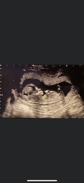 Scan at 13 weeks told it was a boy