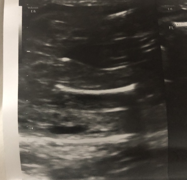 Babies legged crossed 20 week scan