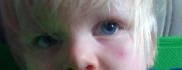 My son has a spot on his face and it is making under his eye pink!? Help!