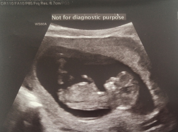 Reassurance needed! 11 weeks and small bleed after BM :(