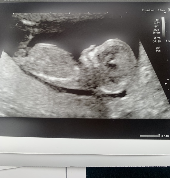 What do you think? Boy or girl?