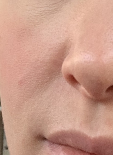 Large pores and blush