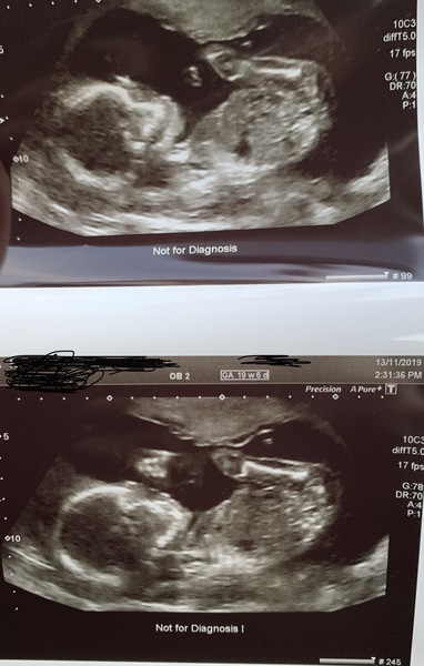 Due March 2020 - FIRST BABY in late 20's