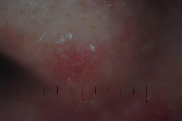 Neoplasm on the nose