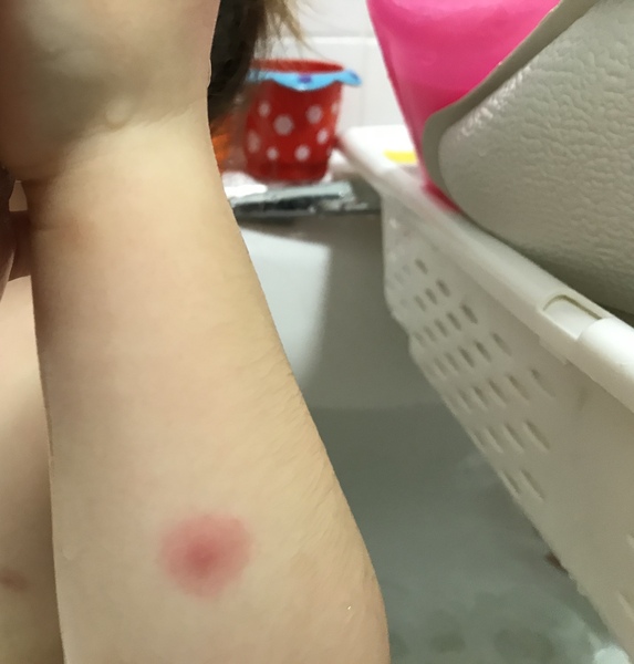 Is this just a bite?? Pic attached!