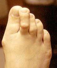 Daughter's bent toes......