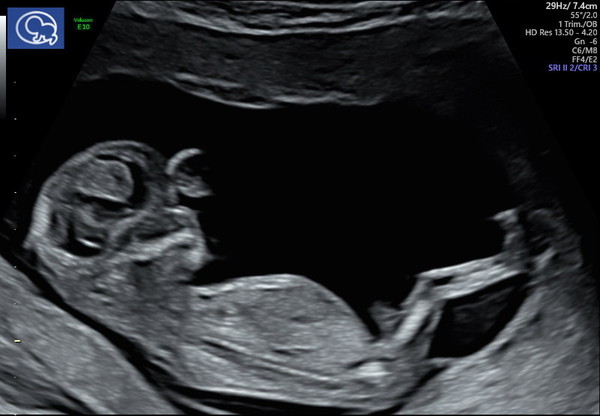 Due May 2020 (thread 3)
