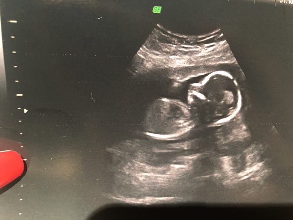 Terrified of Edwards Syndrome