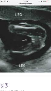 Babies legged crossed 20 week scan
