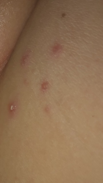 To think this is chicken pox again?