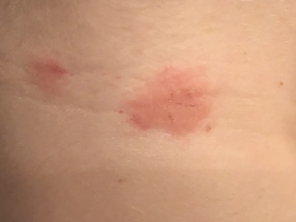 Does this look like eczema, psoriasis or something else?