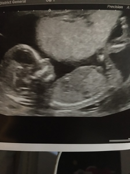 14 week scan photo (boy or girl ) 🤔