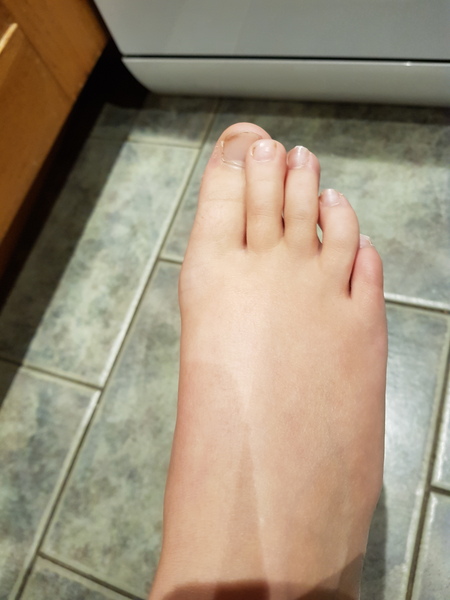Daughter's bent toes......