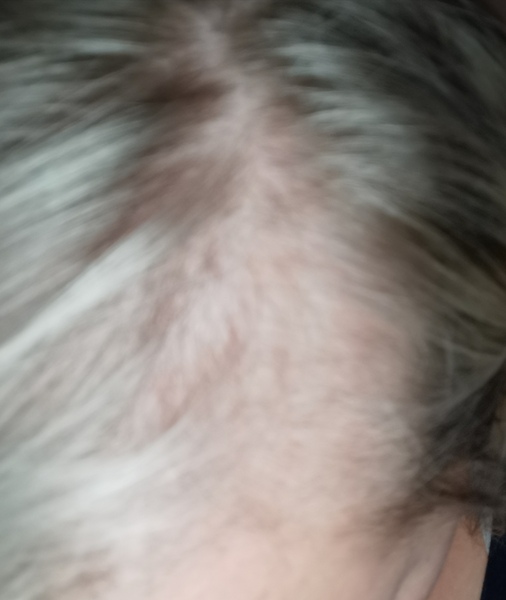 Hairs falling out