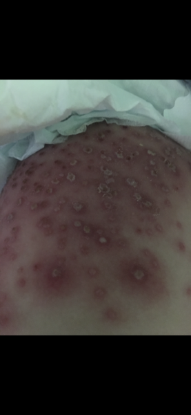 Any medical folk about? Worried about baby's chickenpox URGENT