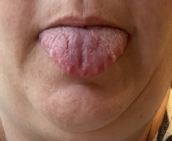 Enlarged scalloped tongue