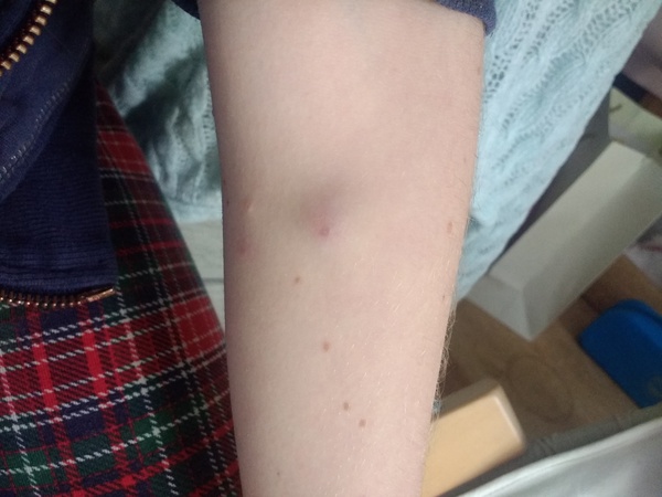 What's this on DD's arm?