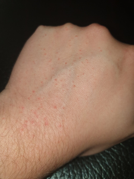 Rash (pic)