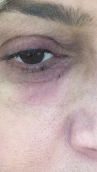 Reaction to eye cream