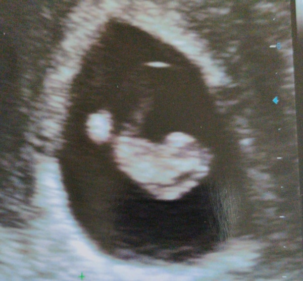 Dating Scan at 8 weeks - is this normal?