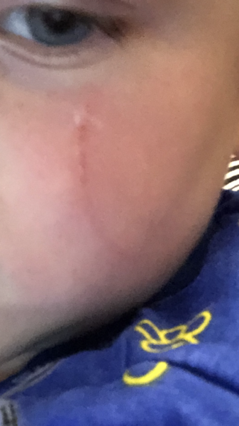 Will his cheek scar?