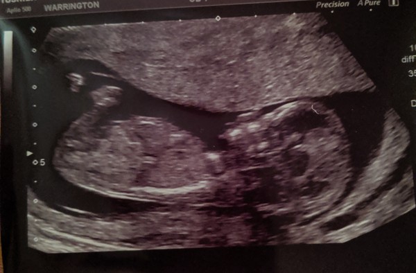Boy/girl guesses?
