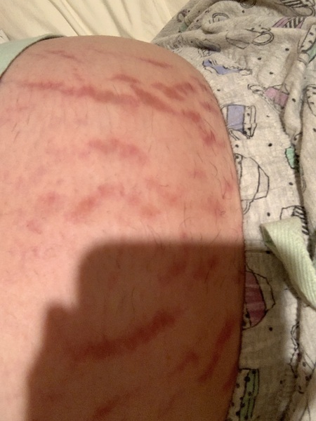 Stretch marks