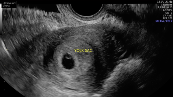 Early Scan No Fetus Help!