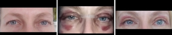 Has anyone had blepharoplasty?