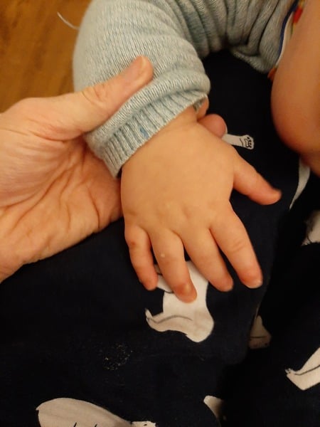 Hand foot and mouth- does this look normal?